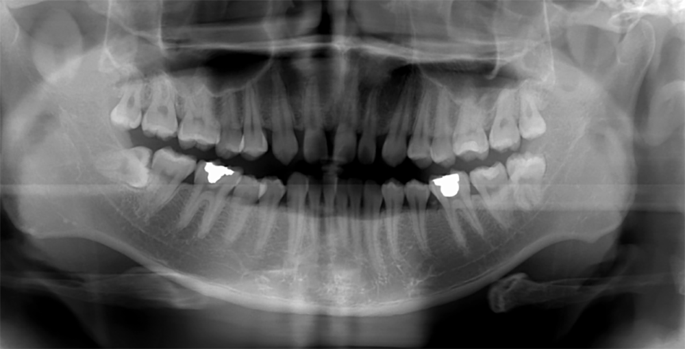 案例－植牙矯正前－台中南屯彭光偉牙醫