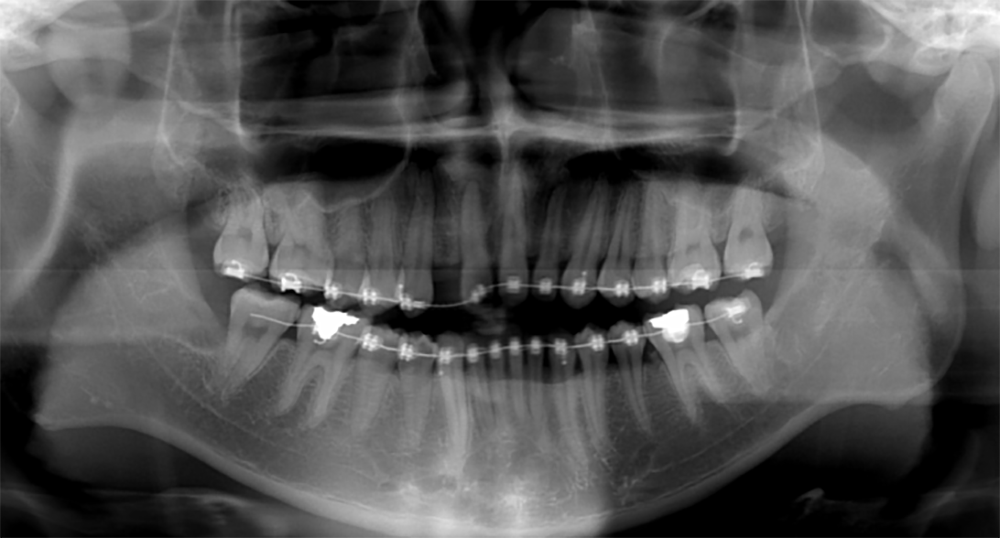 案例－植牙矯正中－台中南屯彭光偉牙醫