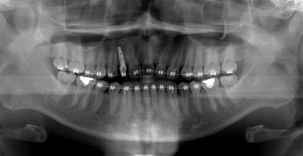 案例－植牙矯正後－台中南屯彭光偉牙醫