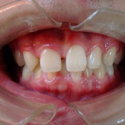 案例－植牙矯正後－推薦台中南屯彭光偉牙醫