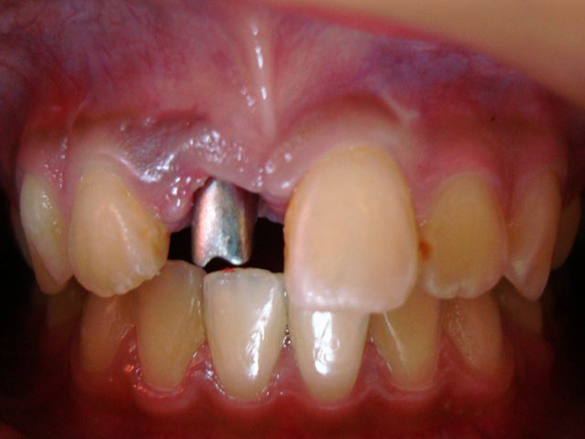 成功案例－植牙矯正（前）－推薦台中南屯彭光偉牙醫
