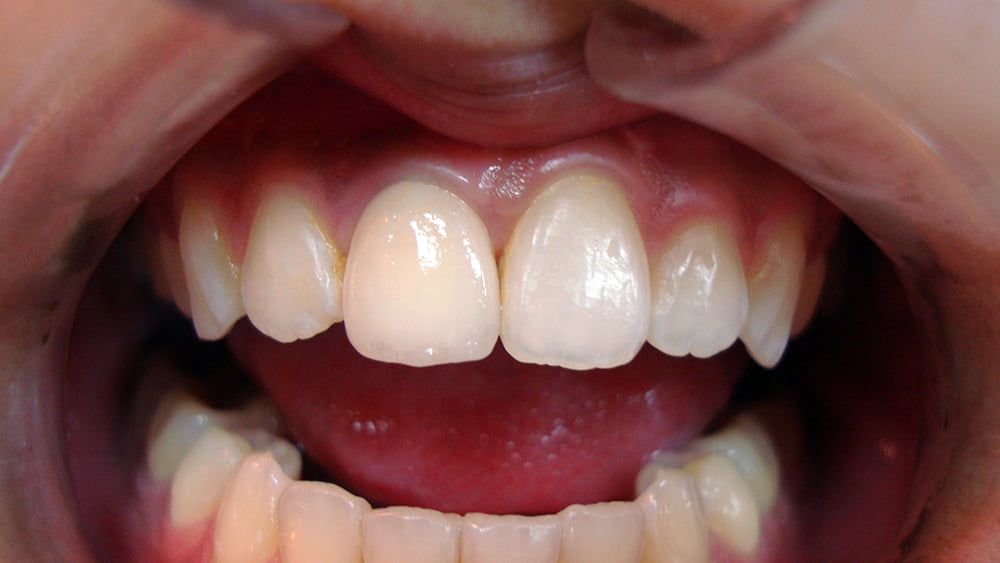 人工植牙成功案例（療程後）－台中南屯彭光偉牙醫