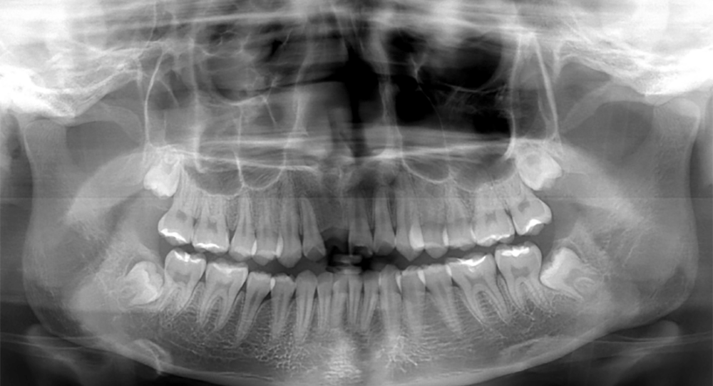 人工植牙成功案例（療程前）－台中南屯彭光偉牙醫