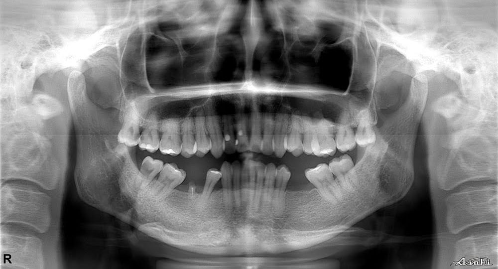 Artificial-dental-implant-Orthodontics.jp4-1