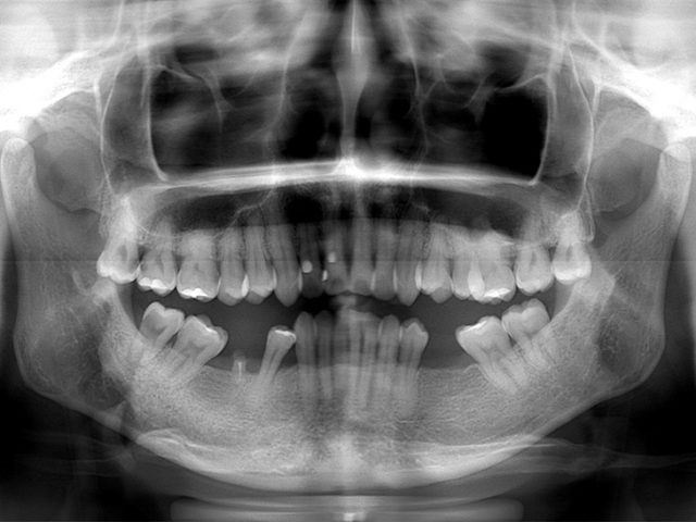 Artificial-dental-implant-Orthodontics.jp4-1