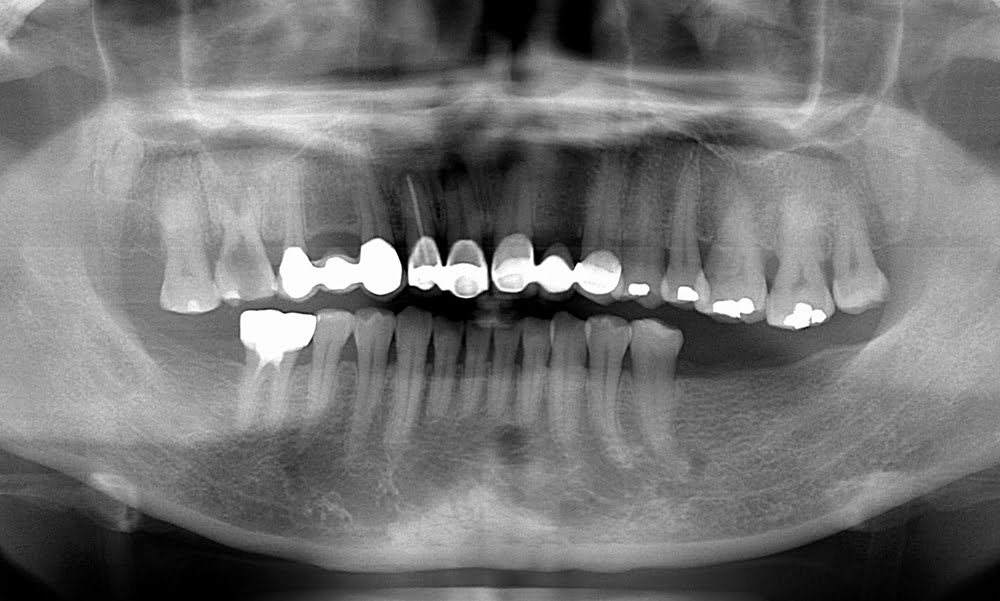 植牙配合根管治療(缺牙咬合塌陷)(前)－台中南屯彭光偉牙醫