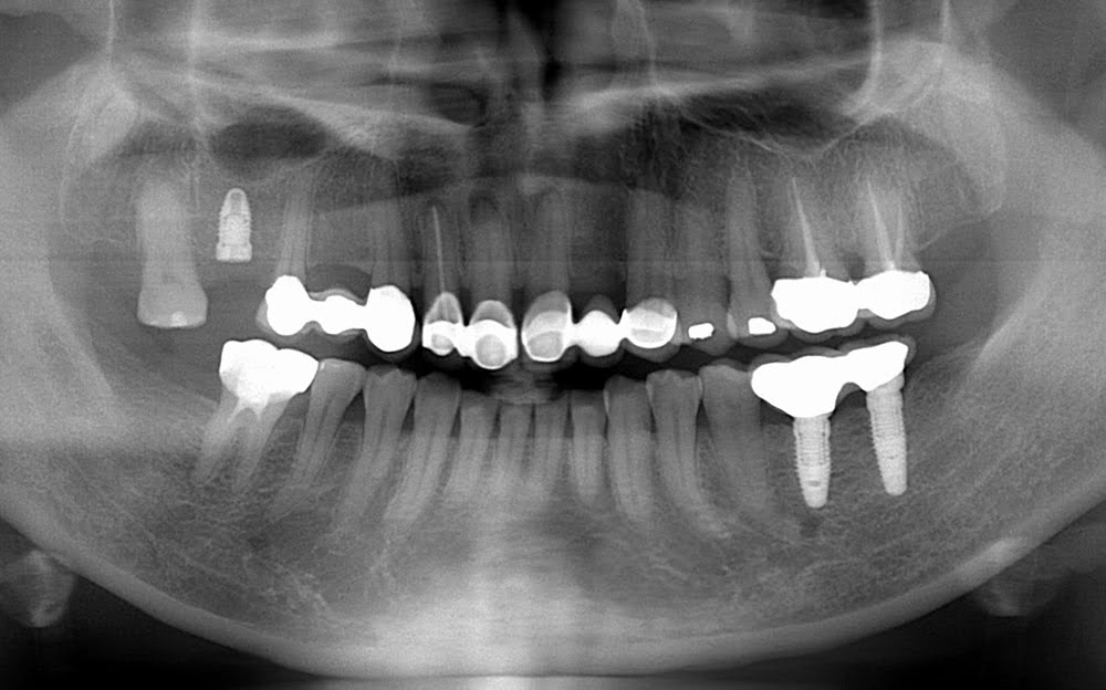 植牙配合根管治療(缺牙咬合塌陷)(後)－台中南屯彭光偉牙醫