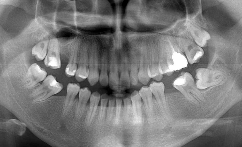 植牙搭配矯正（治療前）－推薦台中南屯彭光偉牙醫