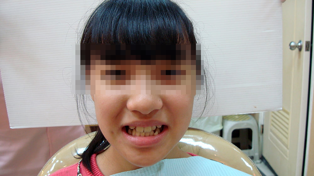 牙齒矯正案例分享-彭光偉牙醫-台中南屯牙醫推薦