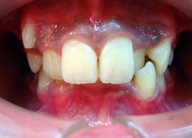 矯正牙齒案例-牙齒矯正前咬合照​-彭光偉牙醫診所