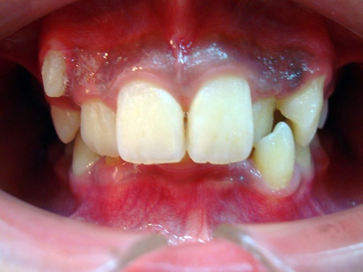 矯正牙齒案例-牙齒矯正前咬合照​-彭光偉牙醫診所