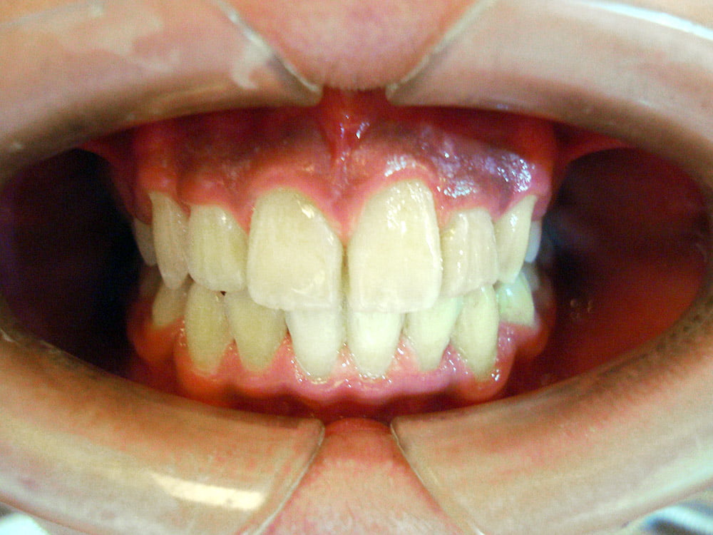 牙齒矯正案例分享(矯正後)-治療後-彭光偉牙醫-台中南屯牙醫推薦