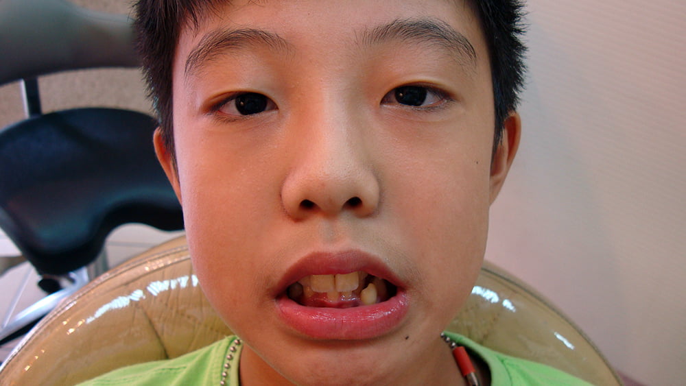 矯正牙齒案例-牙齒矯正前正面照-彭光偉牙醫診所