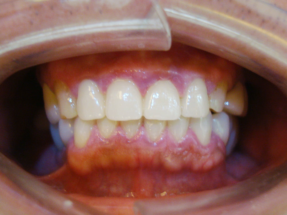 植牙、全口重建－治療前後對照圖－彭光偉牙醫－台中西屯牙醫推薦