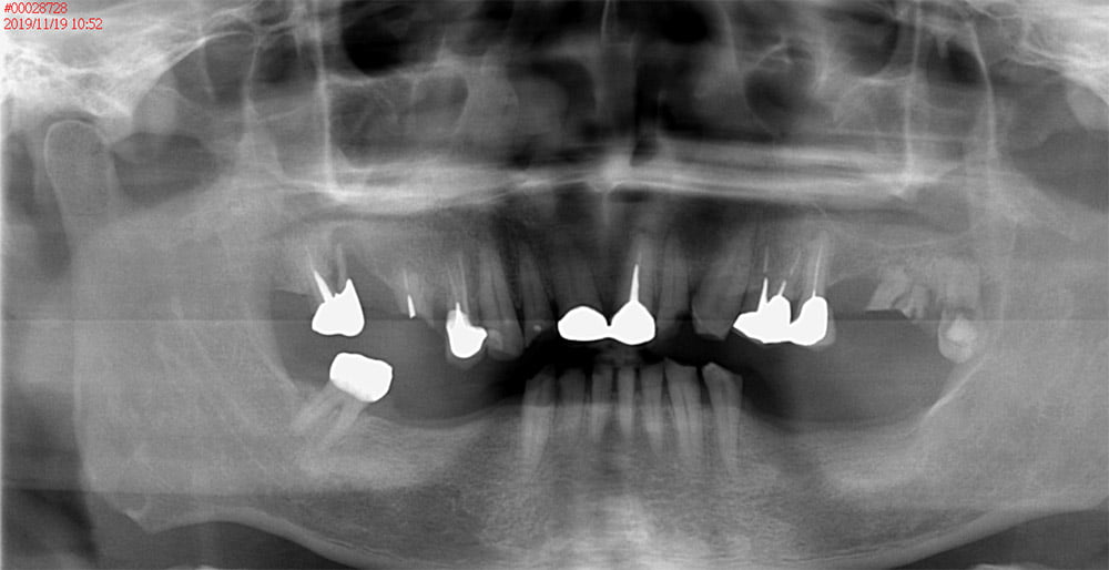 植牙、全口重建－X-ray (治療前)－治療前後對照圖－彭光偉牙醫－台中西屯牙醫推薦