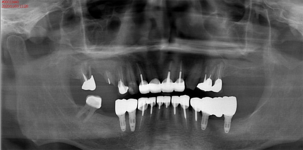 植牙、全口重建－X-ray(治療後)－治療前後對照圖－彭光偉牙醫－台中西屯牙醫推薦