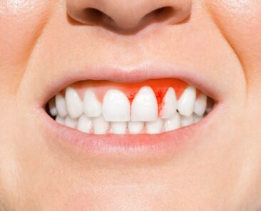 blog-inflamed-gums-causes-treatments-main