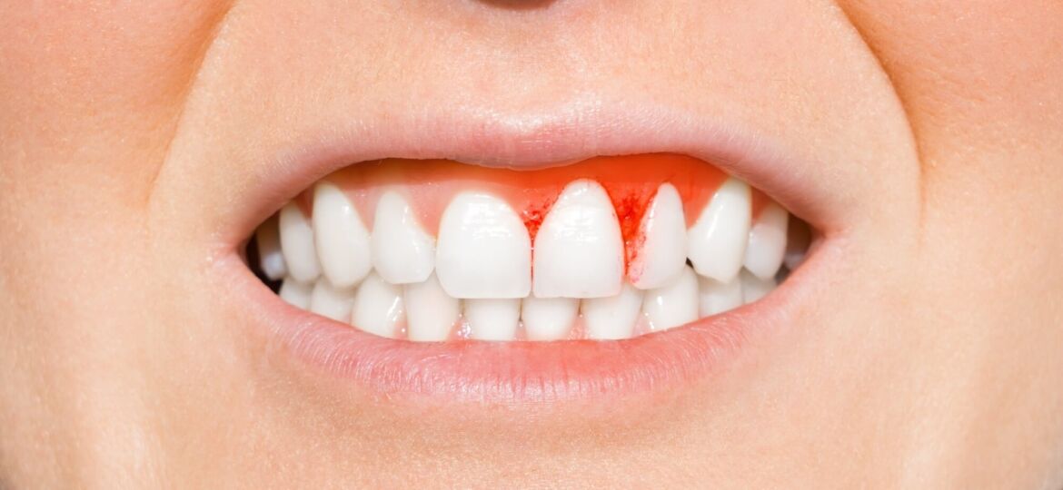 blog-inflamed-gums-causes-treatments-main