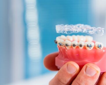 braces-teeth-which-braces-aligners-soar-them