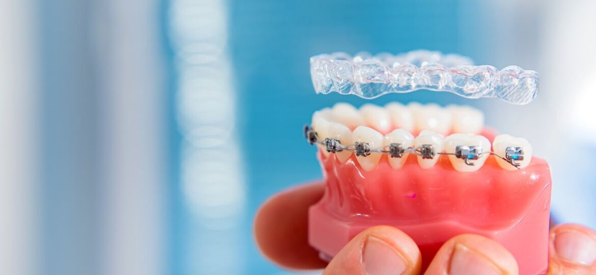 braces-teeth-which-braces-aligners-soar-them