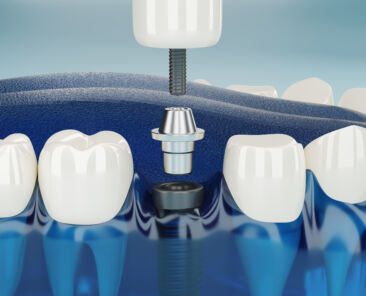 Close up Component of Dental implants transparent. 3D rendering.