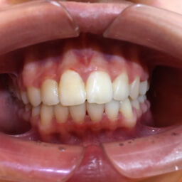 牙齒矯正推薦 - 療程後案例分享 - 台中南屯牙醫診所 - 彭光偉牙醫