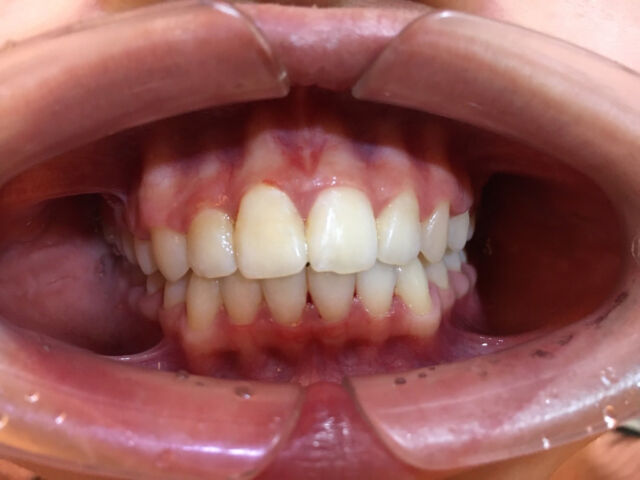 牙齒矯正推薦 - 療程後案例分享 - 台中南屯牙醫診所 - 彭光偉牙醫