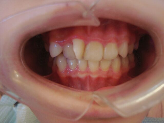 牙齒矯正推薦 - 案例分享 - 台中南屯牙醫診所 - 彭光偉牙醫