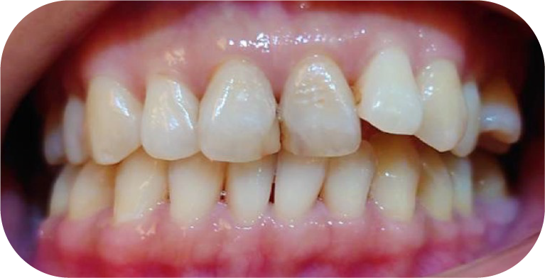 案例：全口矯正+全瓷冠+植牙​（療程前）－推薦台中南屯彭光偉牙醫