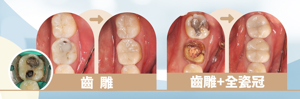 牙齒嚴重蛀牙處理方式－推薦台中南屯彭光偉牙醫
