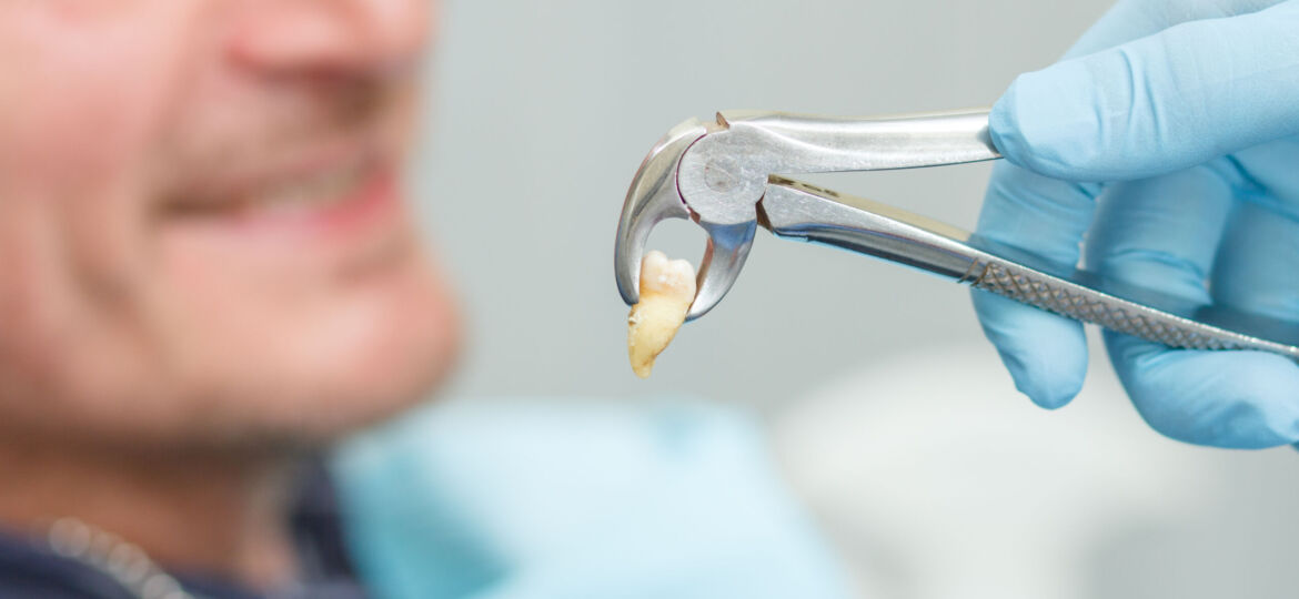 Dentist has extracted a sick tooth from patient in dental office