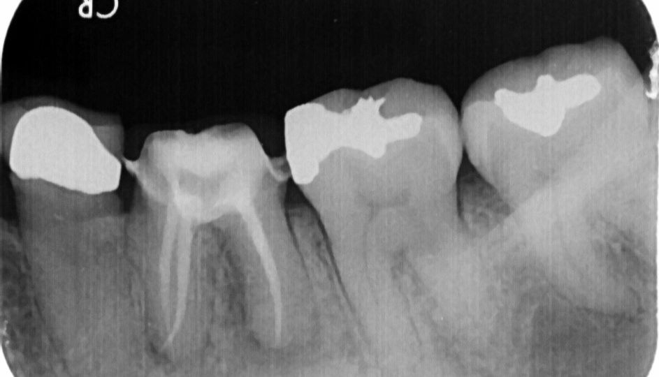 root-canal-therapy-case-220602-wang-2