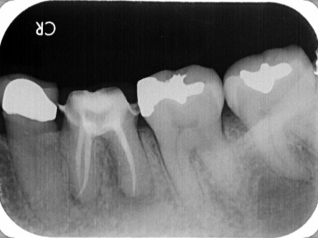 root-canal-therapy-case-220602-wang-2