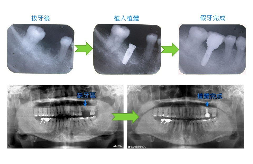 人工植牙流程X光照－台中南屯彭光偉牙醫