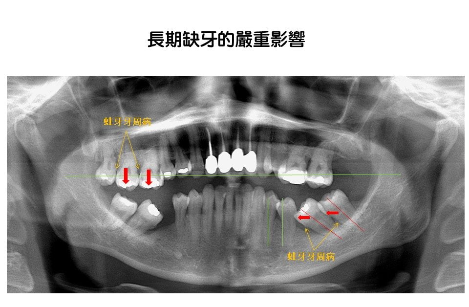 長期缺牙對口腔造成的影響X光照－台中南屯彭光偉牙醫