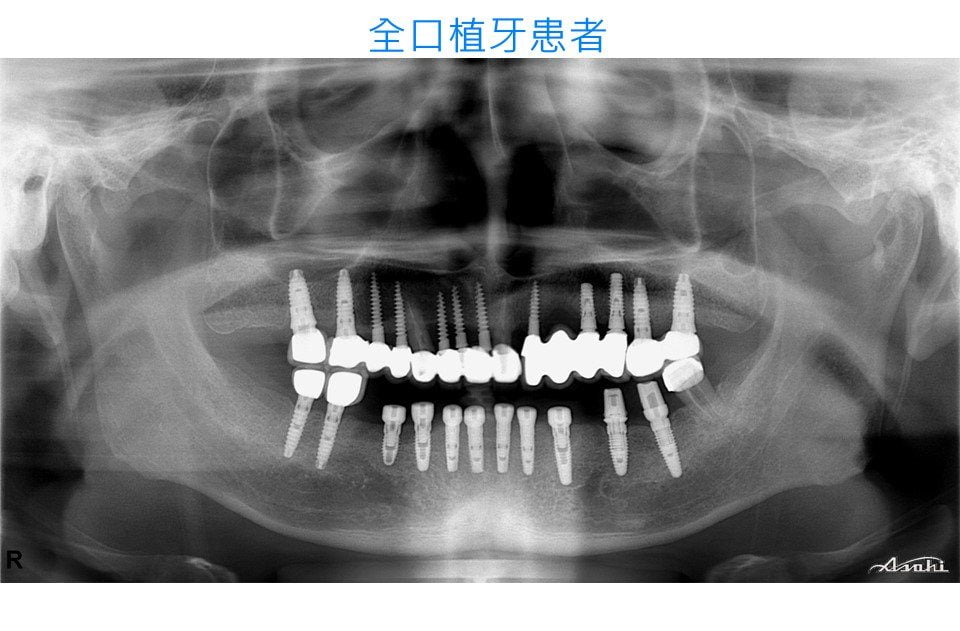 全口植牙案例－台中南屯彭光偉牙醫