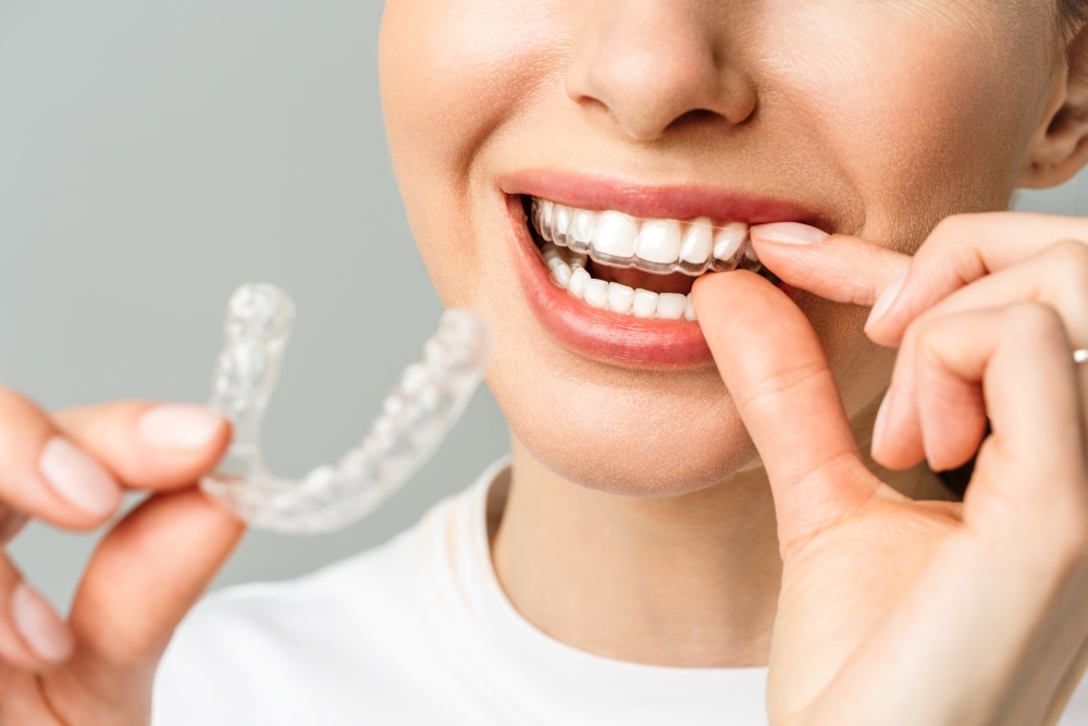 8種牙齒美白方法​-牙齒美白貼片、牙齒美白凝膠（牙托）​