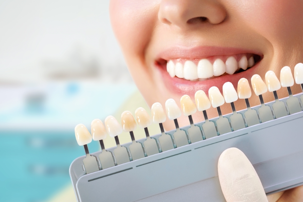 8種牙齒美白方法​-瓷牙貼片(陶瓷貼片)-推薦台中南屯彭光偉牙醫 ​
